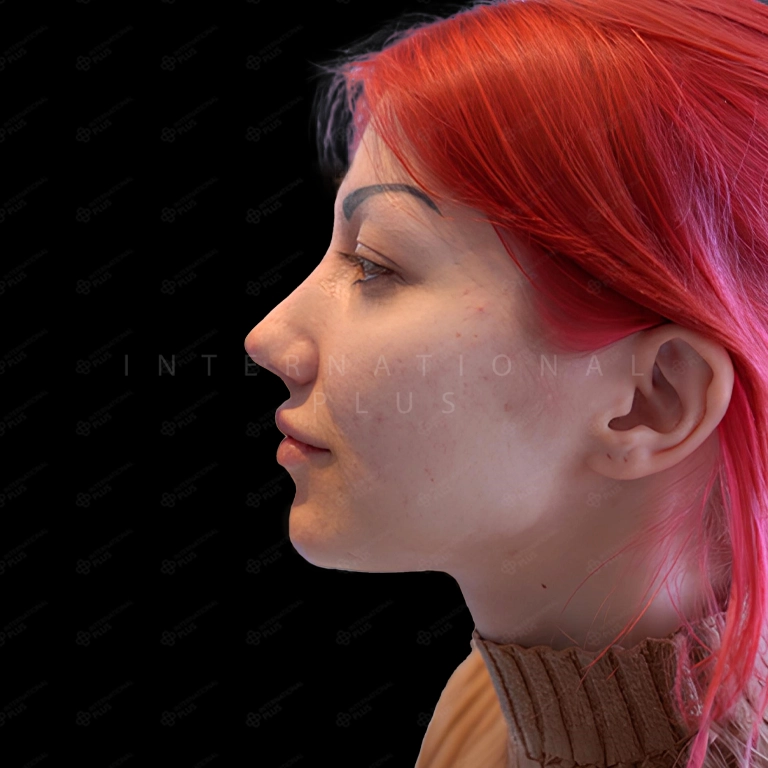 rhinoplasty before after 7