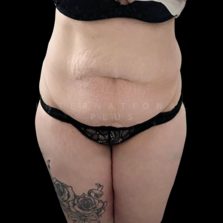 tummy tuck before after 13