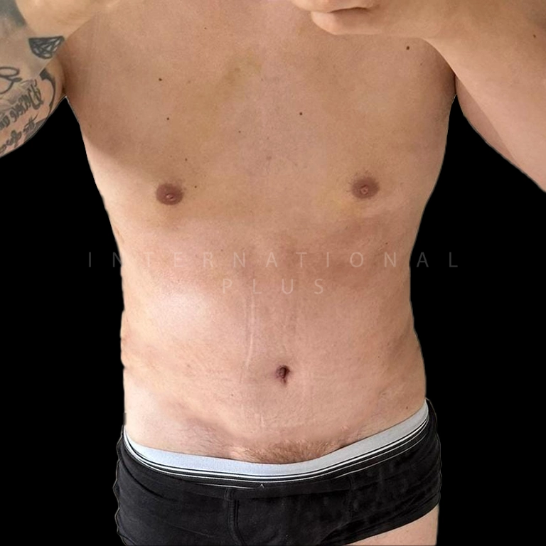 tummy tuck before after 16