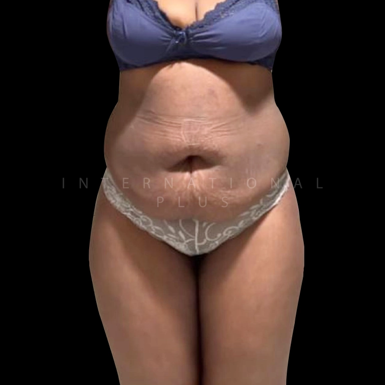 tummy tuck before after 21