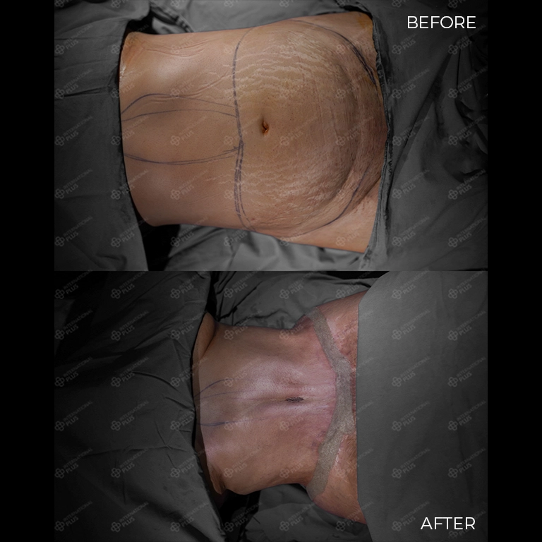 tummy tuck before after 27