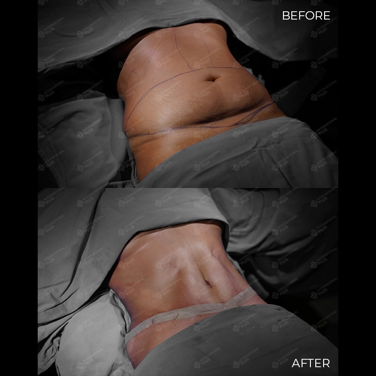 tummy tuck before after 28