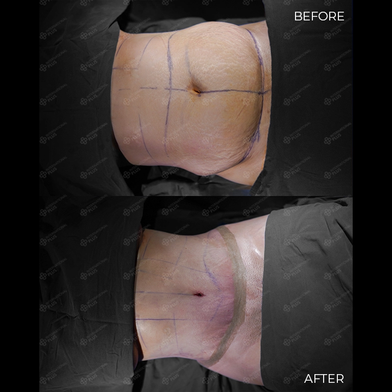 tummy tuck before after 30