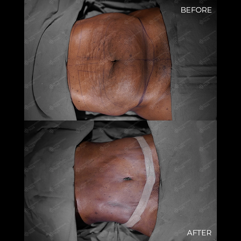 tummy tuck before after 31