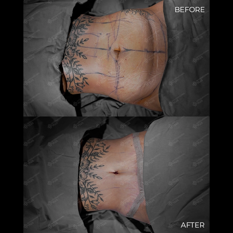 tummy tuck before after 32