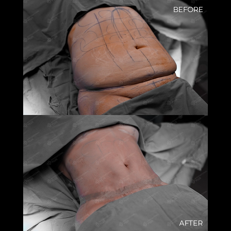 tummy tuck before after 33