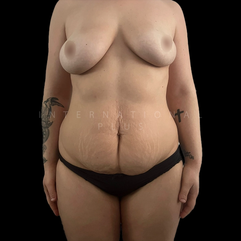 tummy tuck before after 5