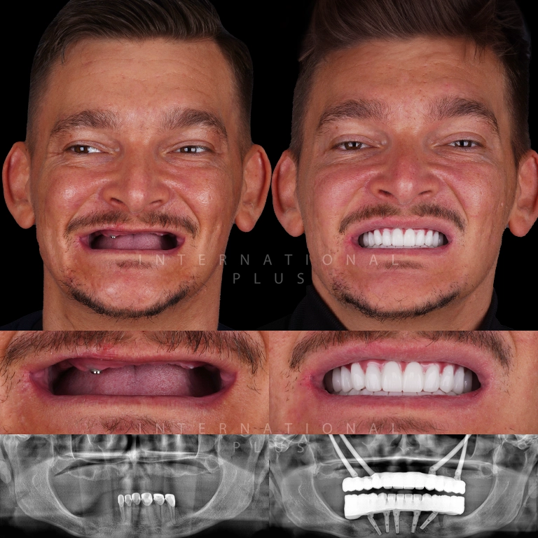 zygoma implant before after 1