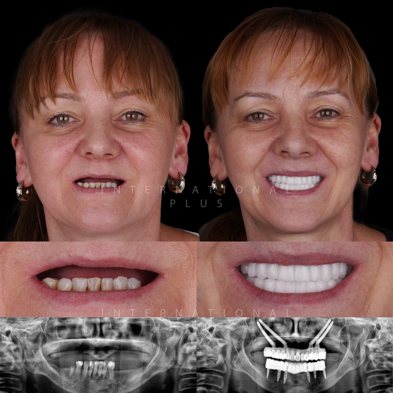 zygoma implant before after 2