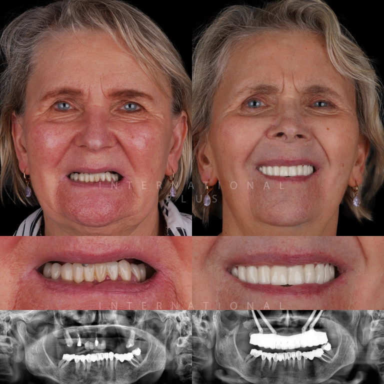 zygoma implant before after 4