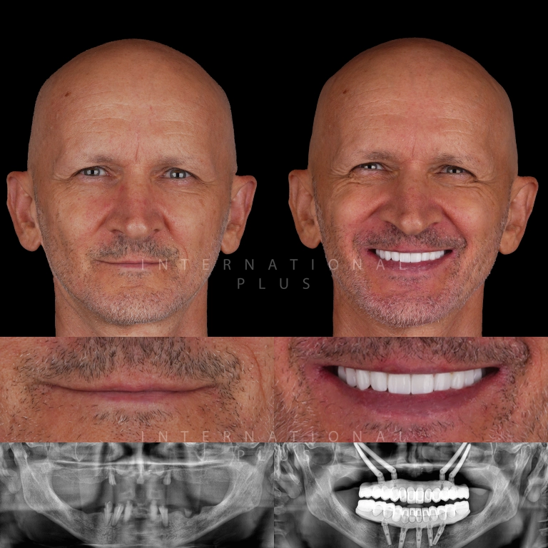 zygoma implant before after 5