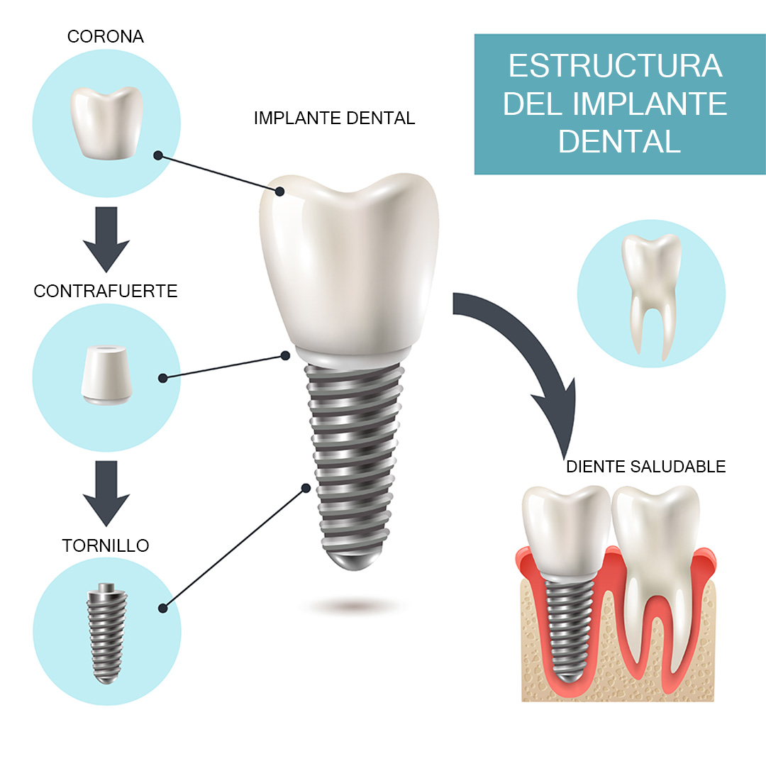 ¿Qué son los implantes dentales_