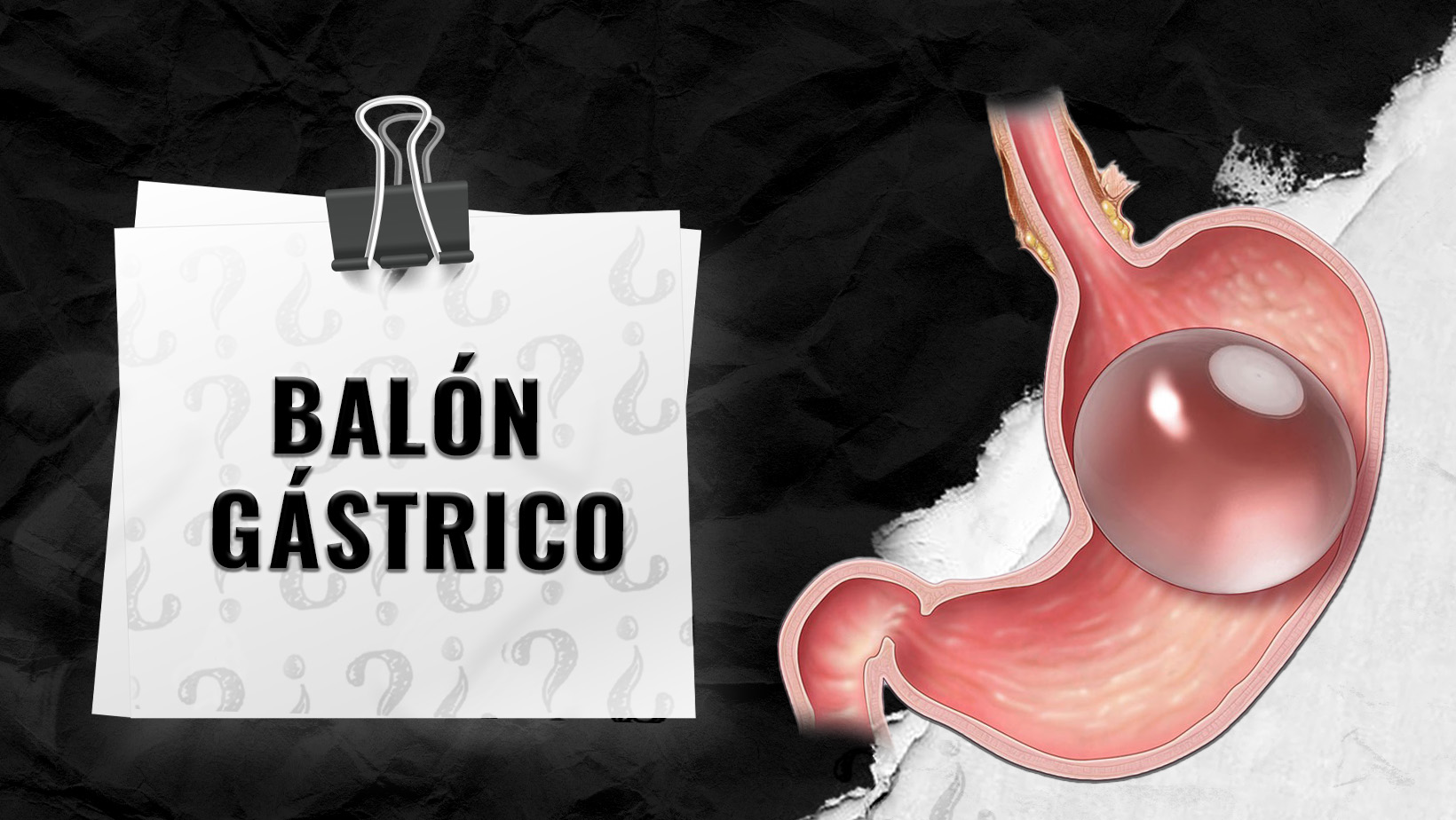 ¿Quien-califica-para-el-balon-gastrico_