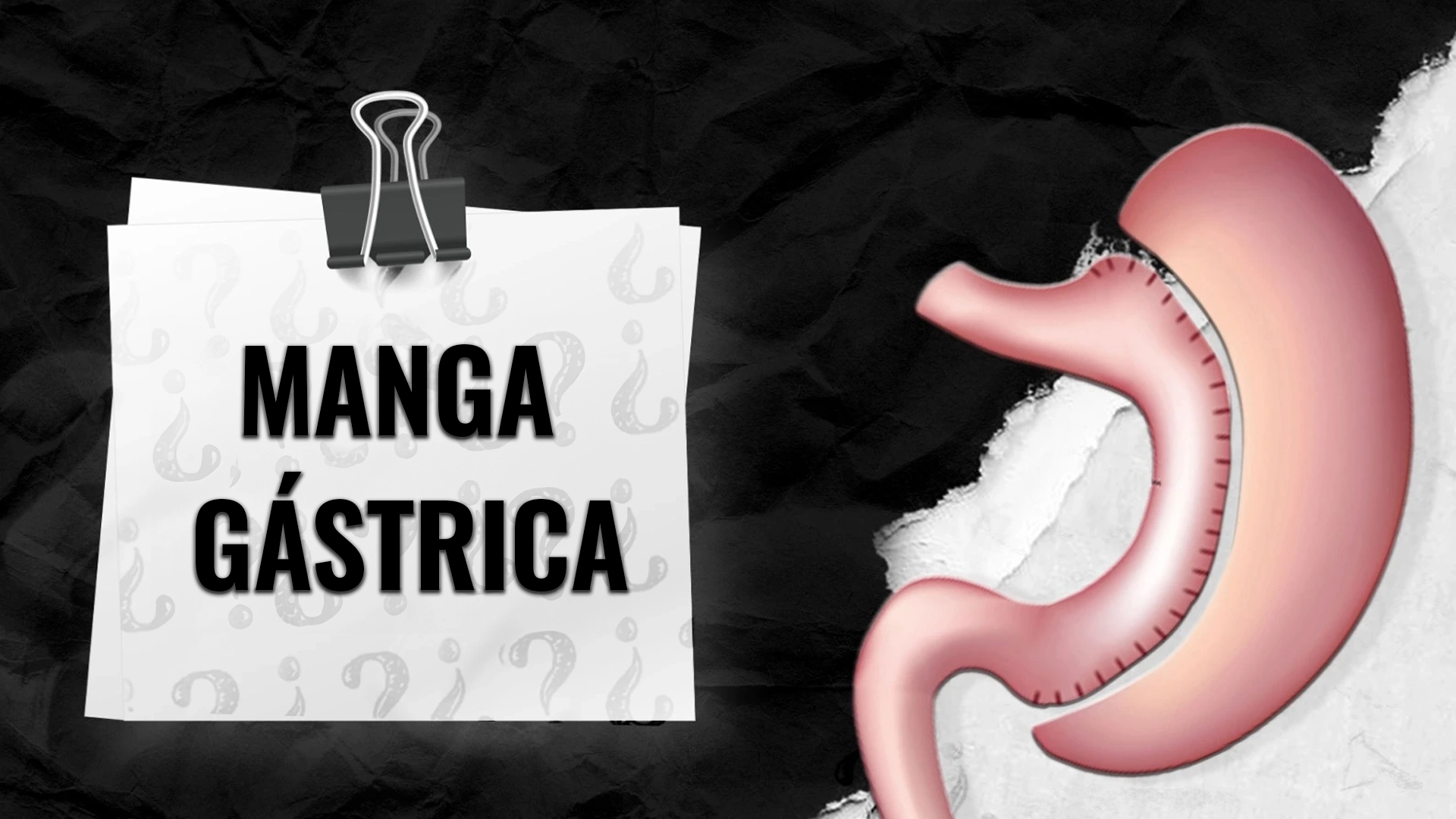 ¿Quien-califica-para-la-manga-gastrica_