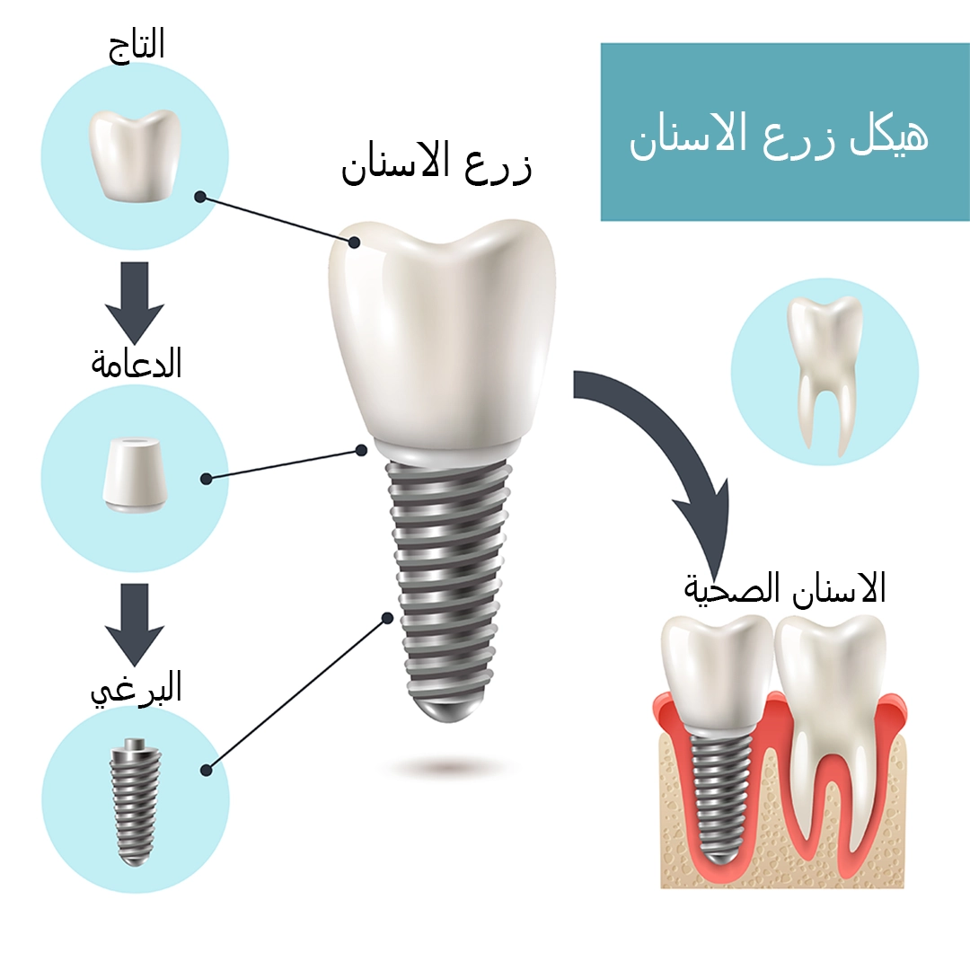 ما هي زراعة الأسنان؟