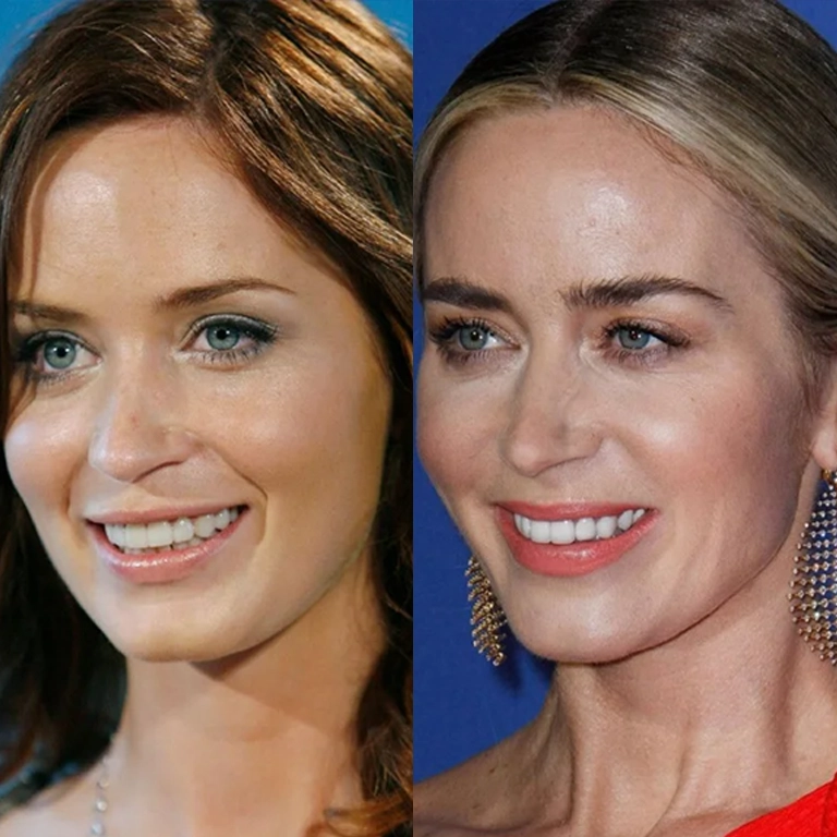 What Are the Most Common Cosmetic Procedures Among Celebrities