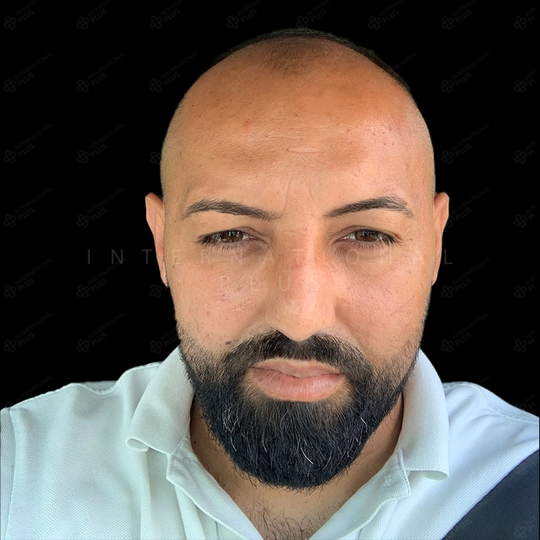 hair transplant before after 1