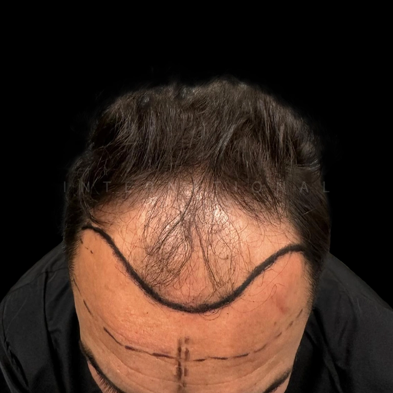 hair transplant before after 11