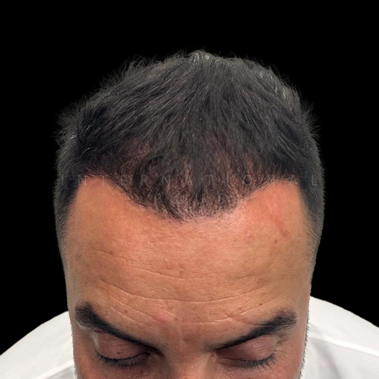 hair transplant before after 12