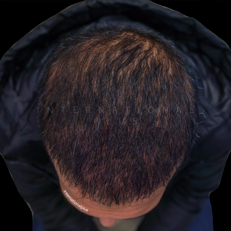 hair transplant before after 16