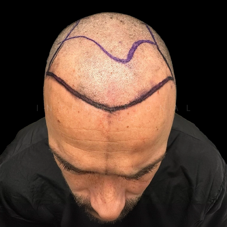 hair transplant before after 7