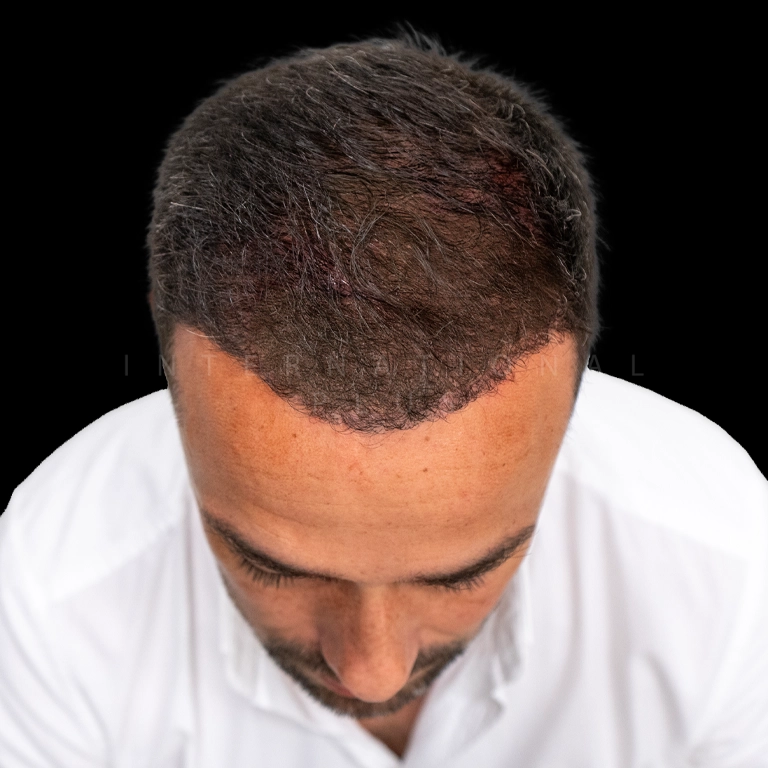 hair transplant before after 8