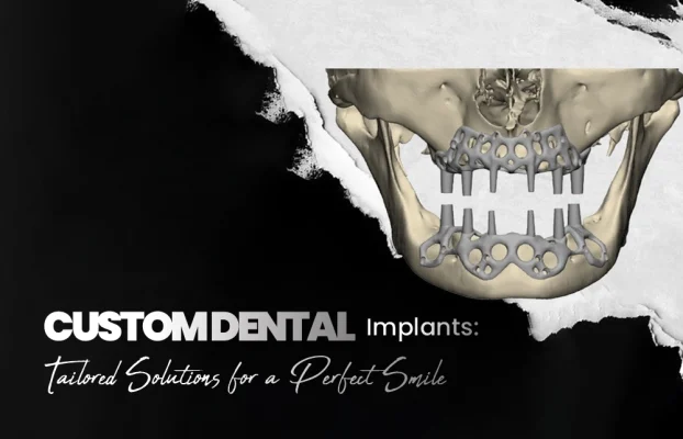 Custom Dental Implants: Tailored Solutions for a Perfect Smile