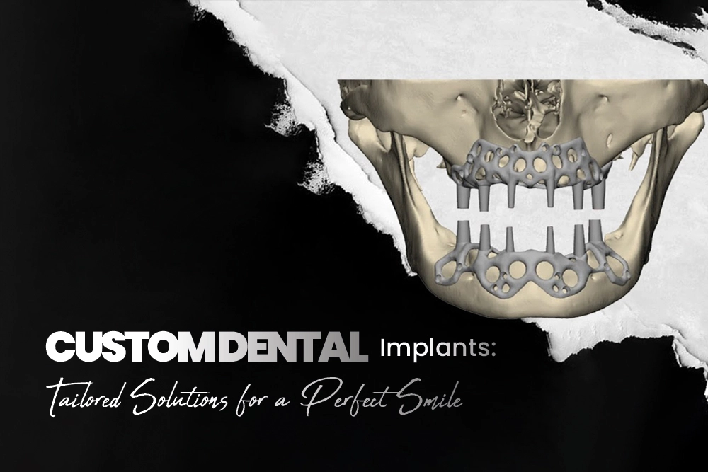 Custom Dental Implants: Tailored Solutions for a Perfect Smile