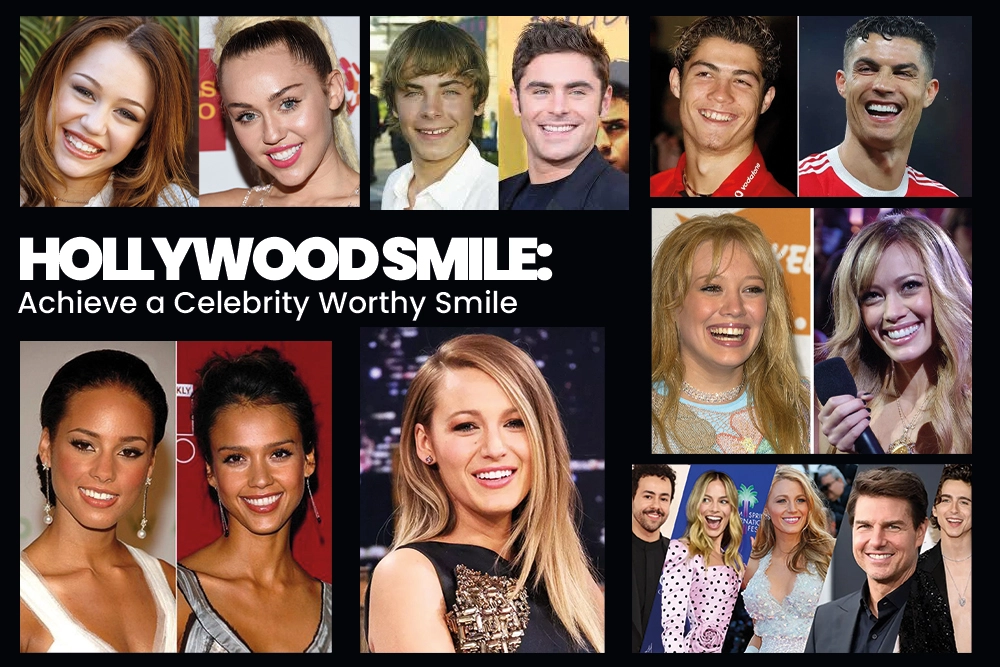 Hollywood Smile Achieve a Celebrity Worthy Dental Smile