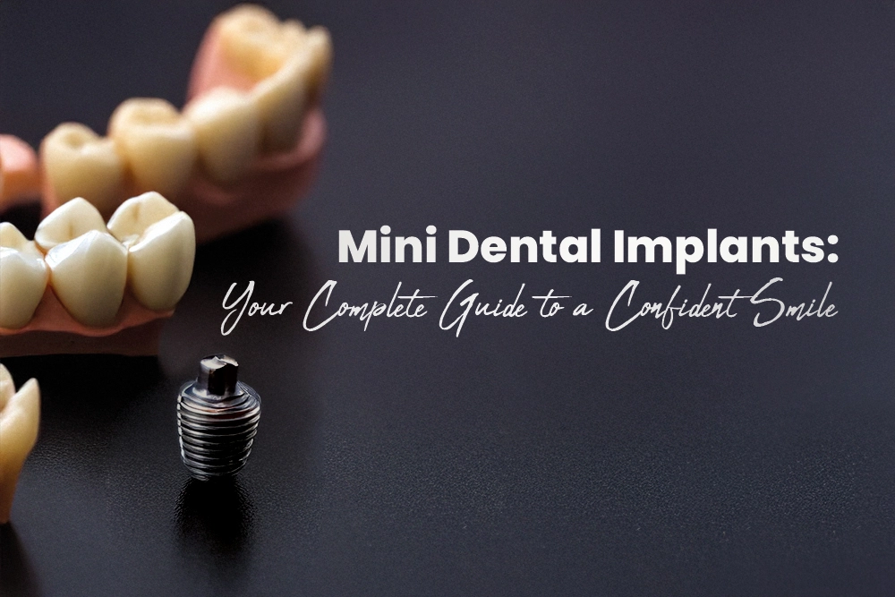 Mini Dental Implants: Your Complete Guide to a Confident Smile