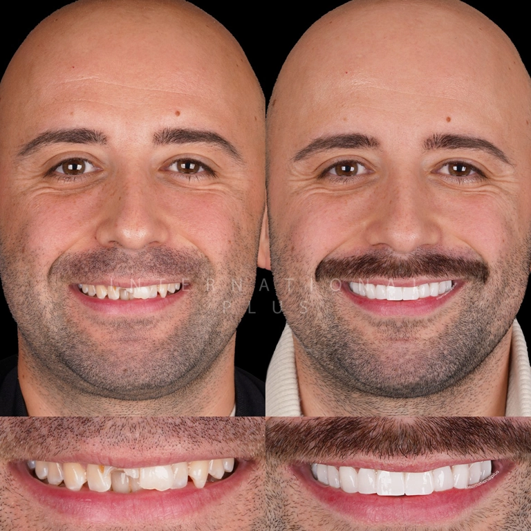 The Benefits of a Dental Hollywood Smile Makeover for Perfect Smile