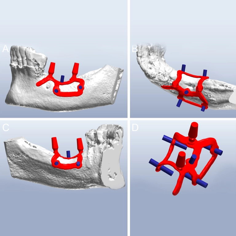 The Custom Implant Placement Process What to Expect