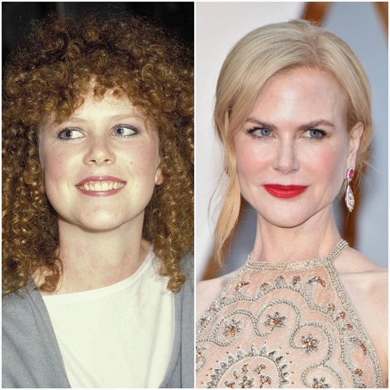 Has Nicole Kidman Had Plastic Surgery 2024