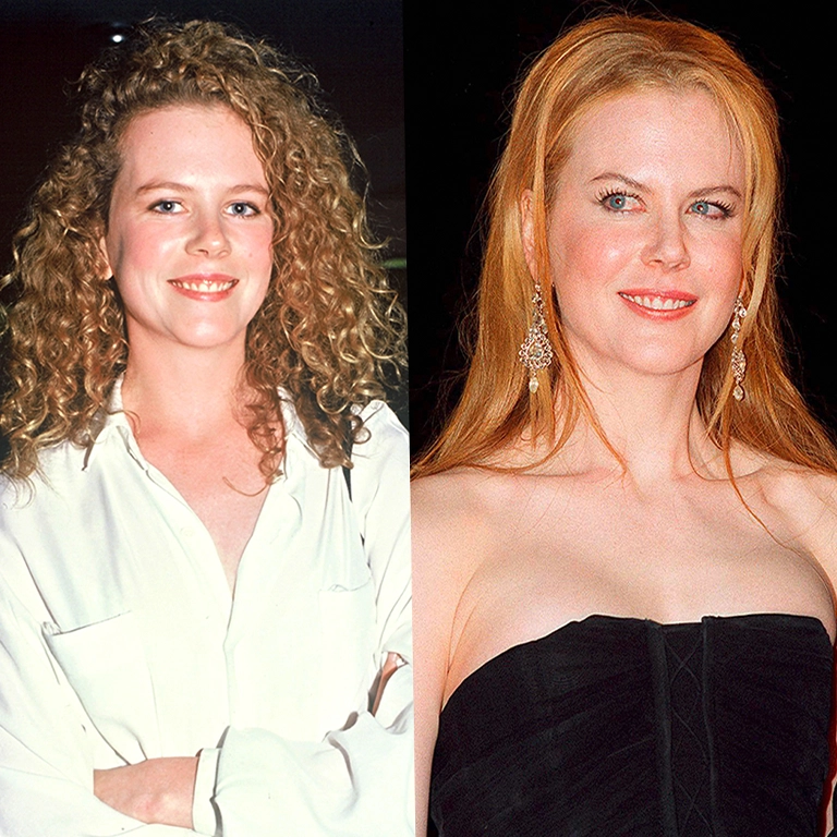 Nicole Kidman Before and After