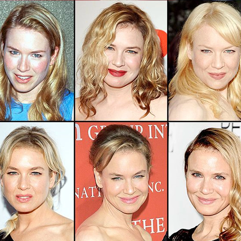 Renée Zellweger Lip Fillers