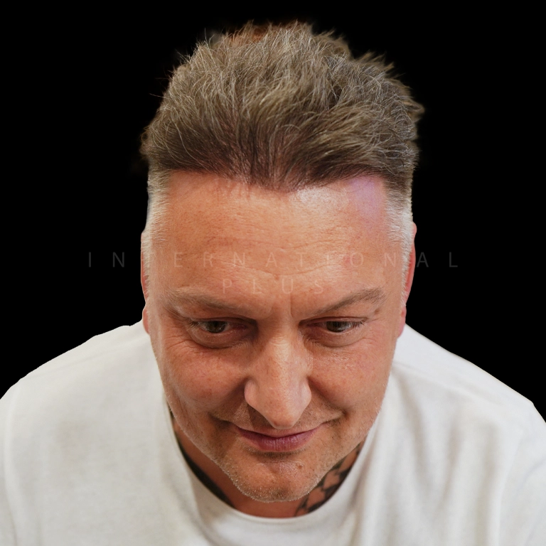All Treatments Before After 14