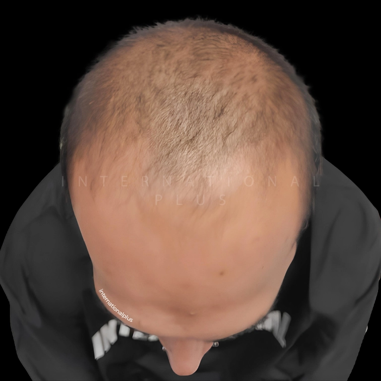 All Treatments Before After 15