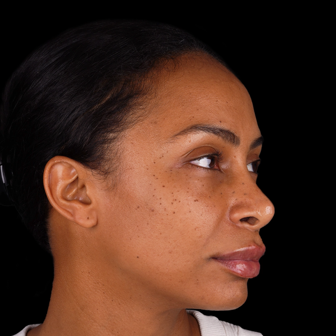 All Treatments Before After 22