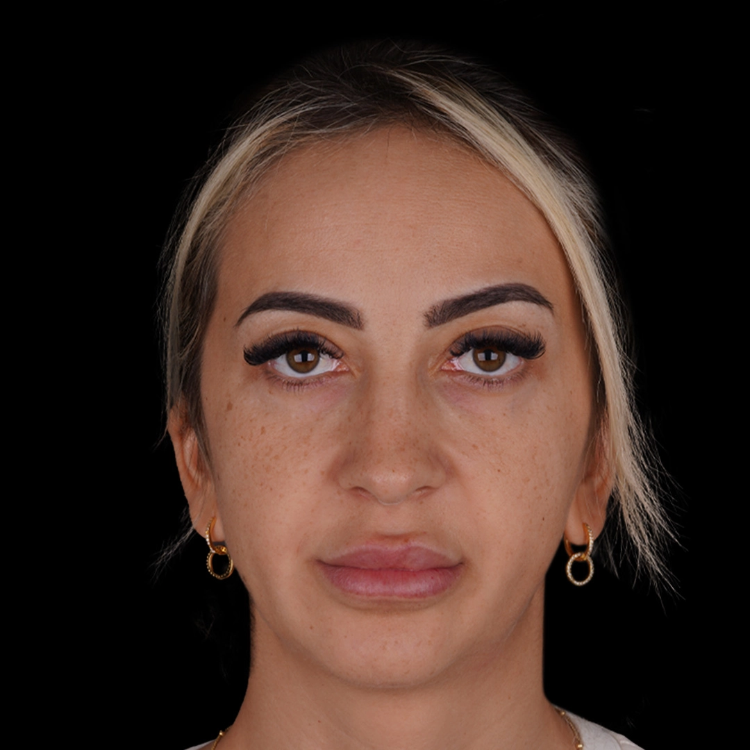 All Treatments Before After 29
