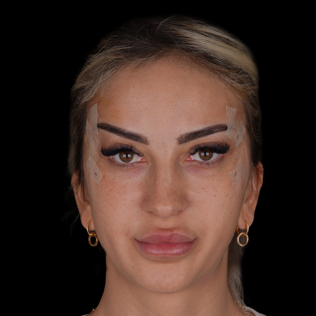 All Treatments Before After 30