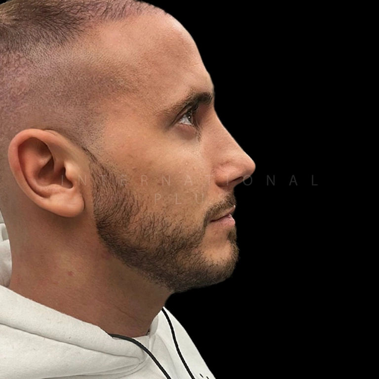 All Treatments Before After 36