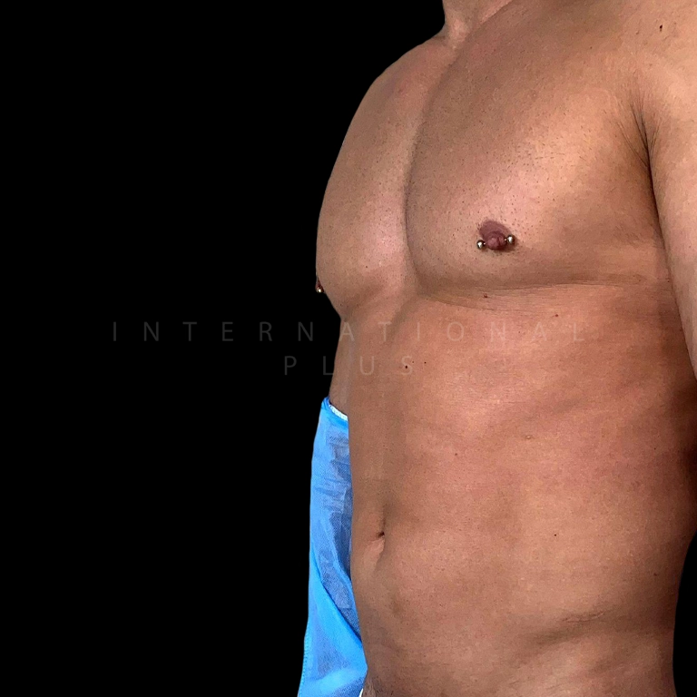 All Treatments Before After 39