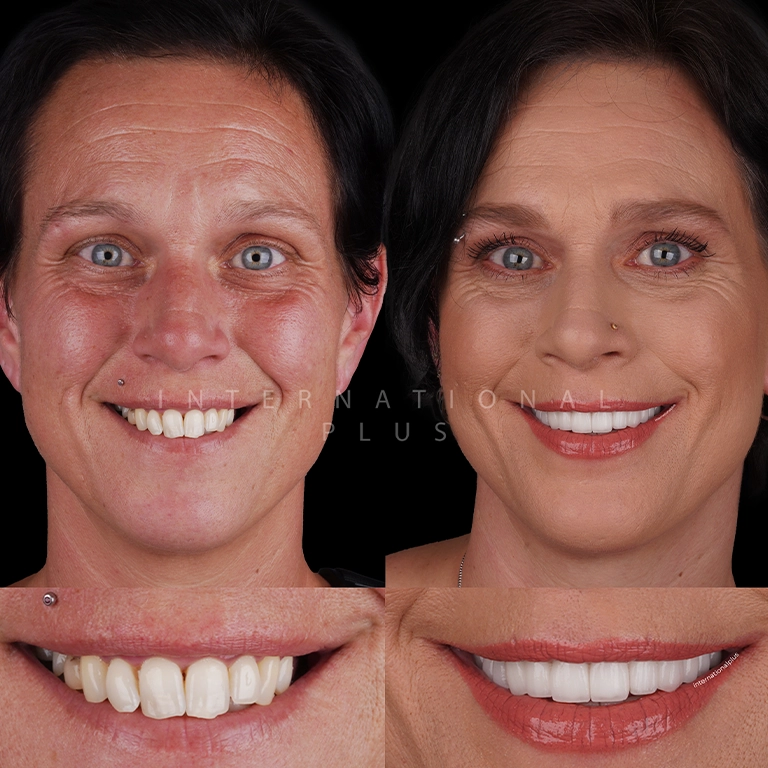 All Treatments Before After 45