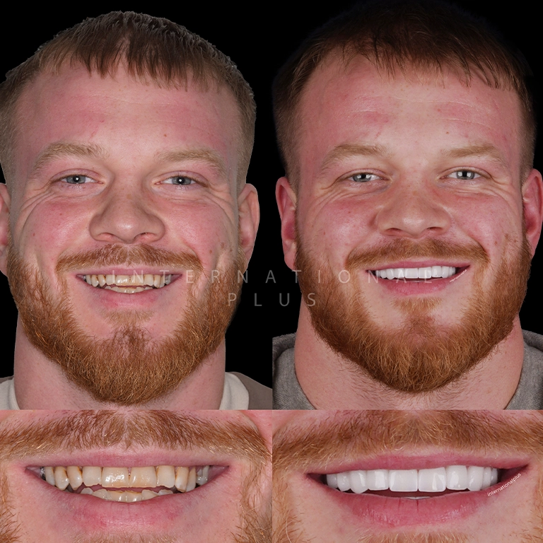 All Treatments Before After 46