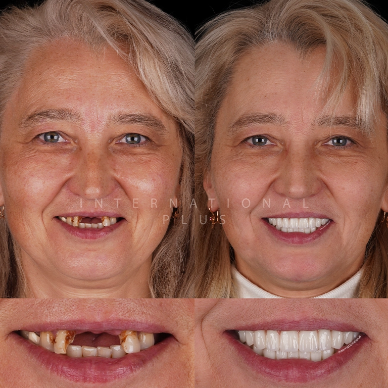 All Treatments Before After 47