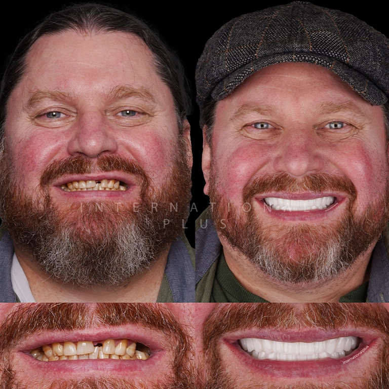 All Treatments Before After 48