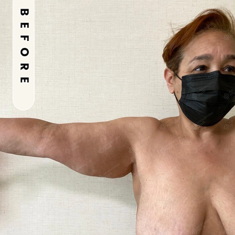 All Treatments Before After 5