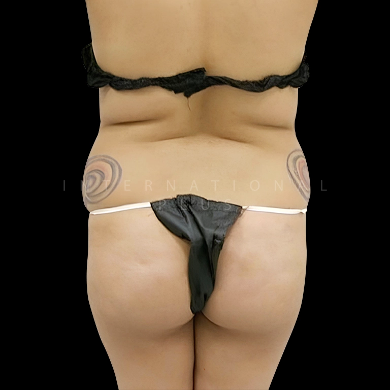All Treatments Before After 7