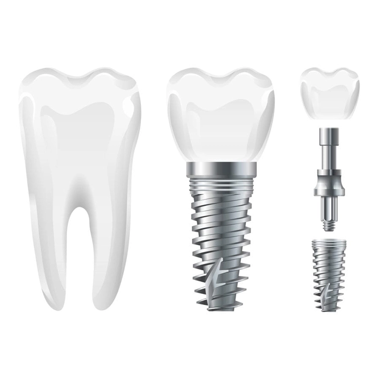 Cost of Turkey Teeth Implants Packages