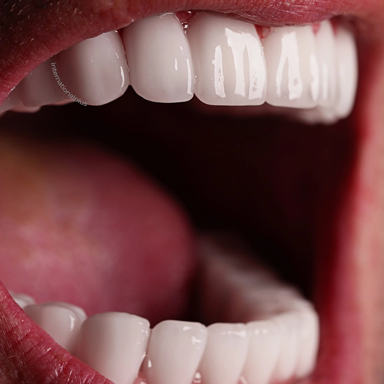 Hollywood Smile Procedure
